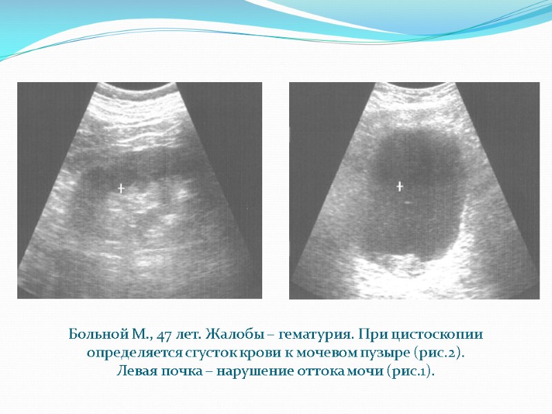Больной М., 47 лет. Жалобы – гематурия. При цистоскопии определяется сгусток крови к мочевом